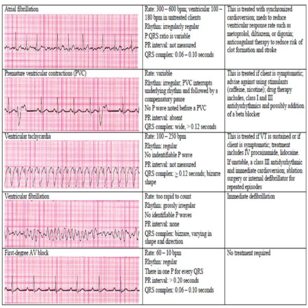 13 cardiac rhythm and dysrhythmias cheat sheet any nurse must know for the exam